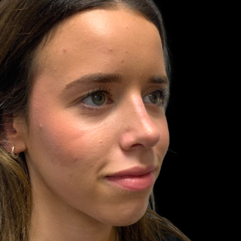 preservation-rhinoplasty-after